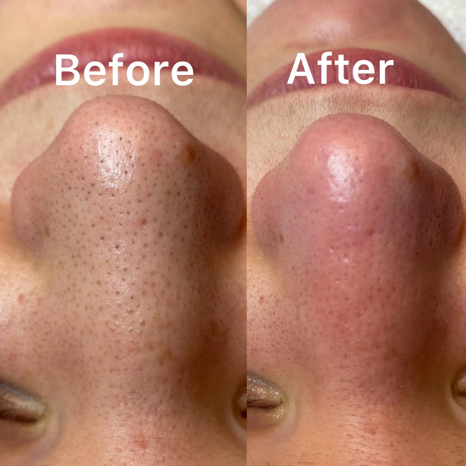 Before and after treatment result for congestion and pore clarity