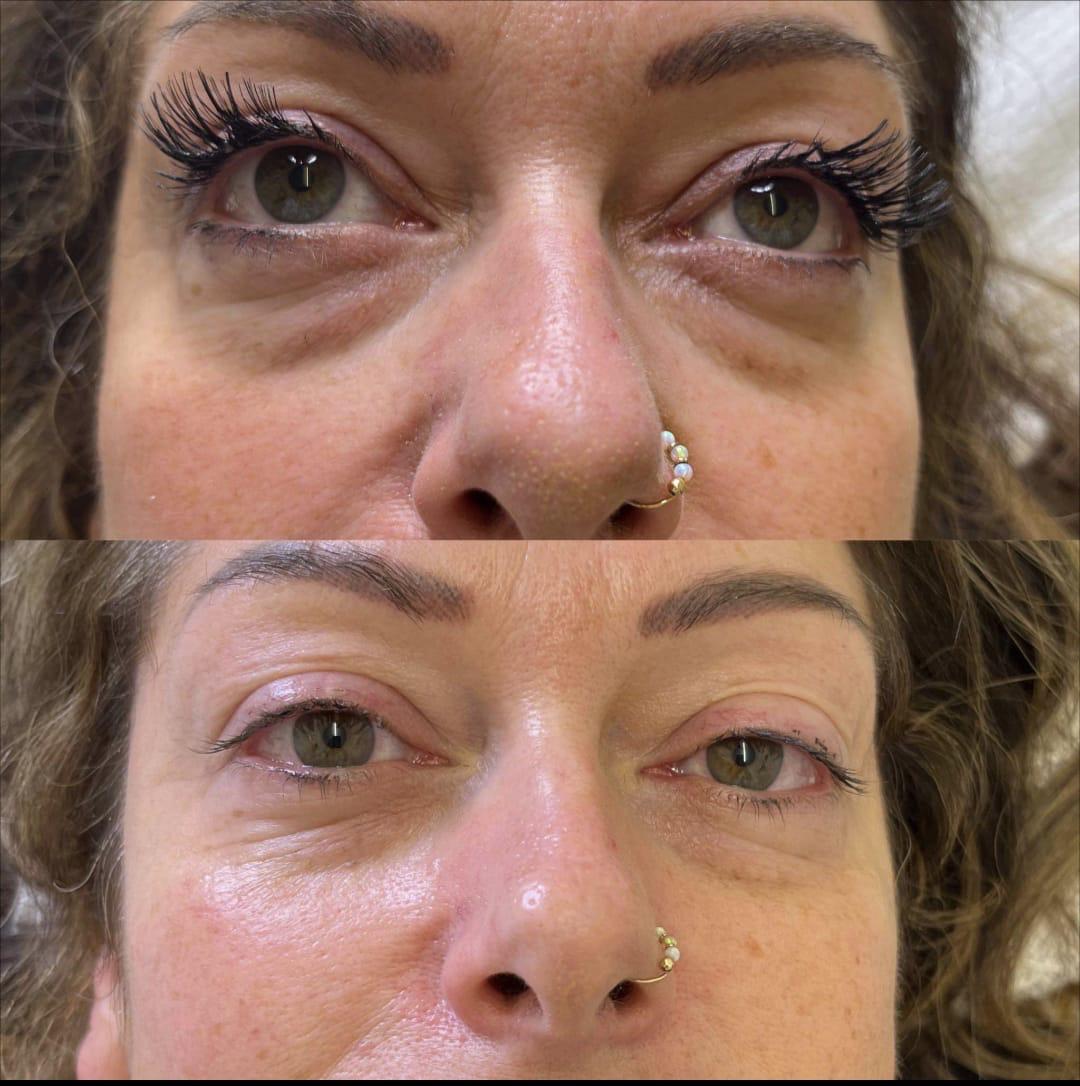 Before and after under-eye rejuvenation result