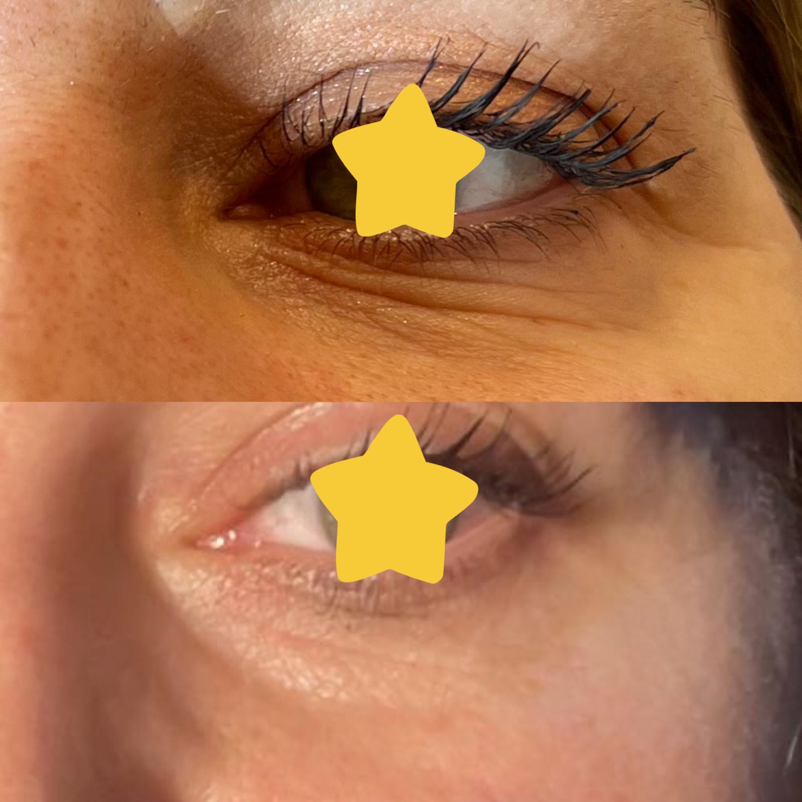 Before and after treatment result for fine lines around the eye