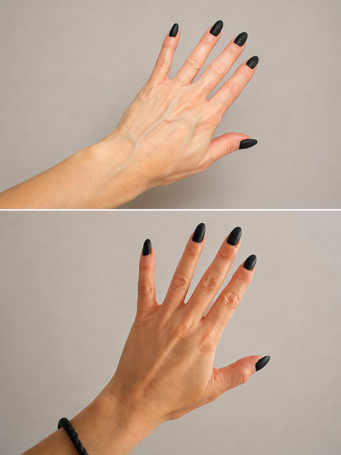 Before and after treatment result showing skin quality on the hands